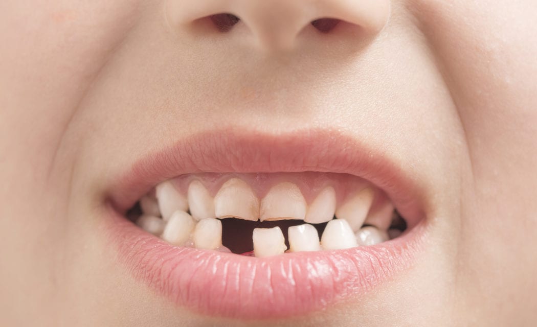 Gold Teeth by Bill Melton